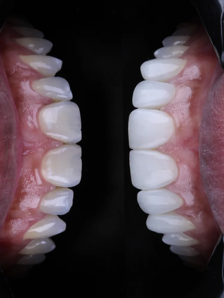 Antes e depois de harmonização do sorriso em resina composta: vista lateral dos dois lados da arcada, com dentes mais brancos e uniformes