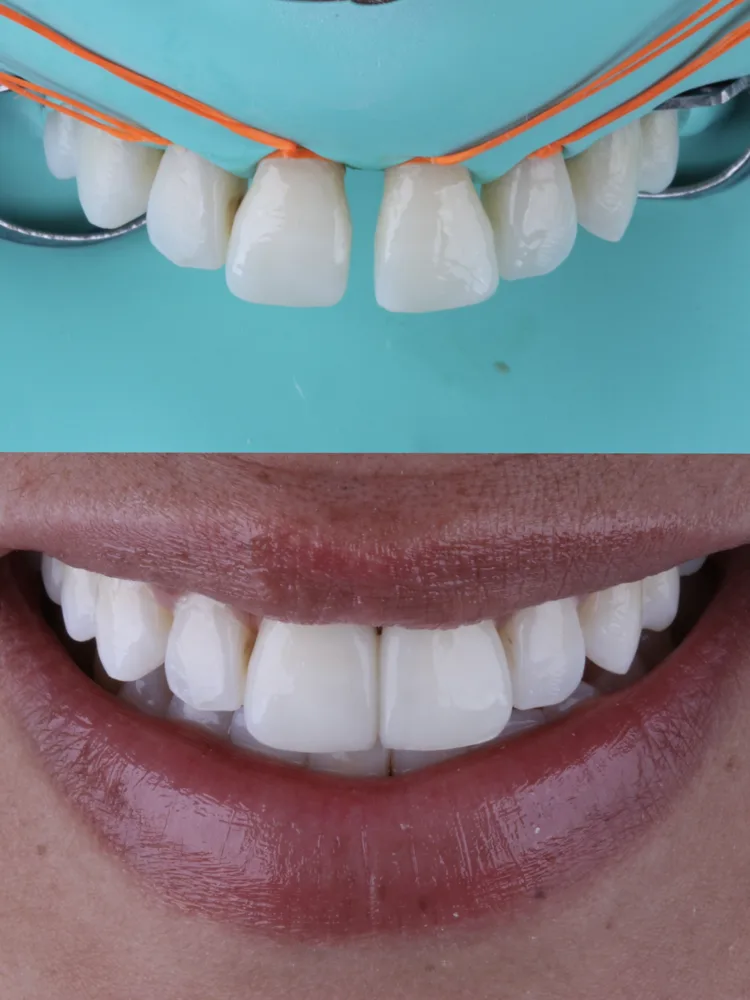 Antes e depois do fechamento de diastema com resina composta: o espaço entre os dois dentes da frente deixa de existir
