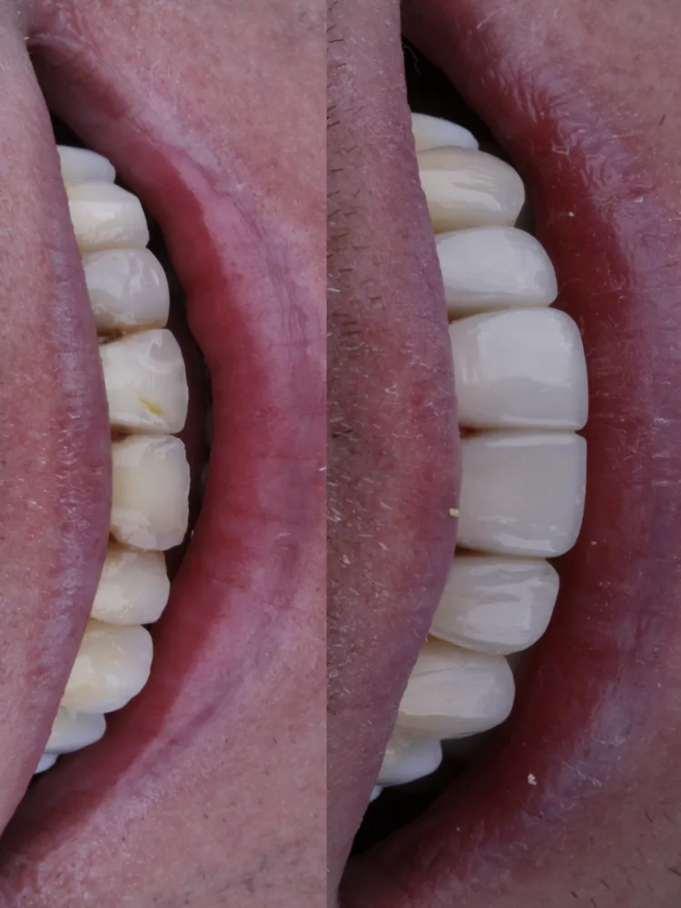 Antes e depois de facetas em resina composta, vista de perfil dos dentes da frente, com forma e cor mais uniformes