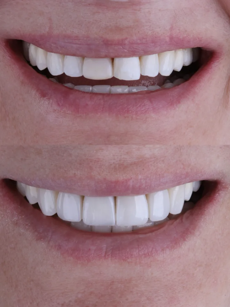 Antes e depois de clareamento e facetas em resina composta: sorriso de frente com dentes mais claros e uniformes
