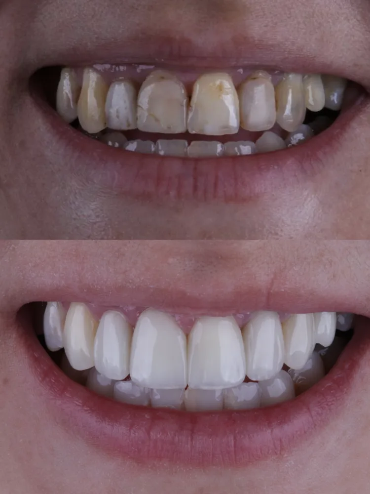 Antes e depois de clareamento e facetas em resina composta: dentes escurecidos e desgastados que ficaram brancos e bem formados