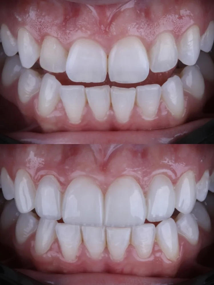Antes e depois de harmonização do sorriso em resina composta: dentes da frente, de cima e de baixo, com formato e cor mais uniformes