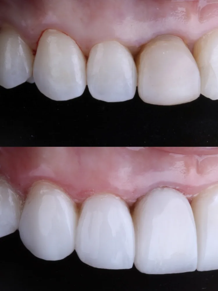 Antes e depois de contorno e proporção em resina composta: vista lateral dos dentes da frente e da gengiva, com formato mais harmônico