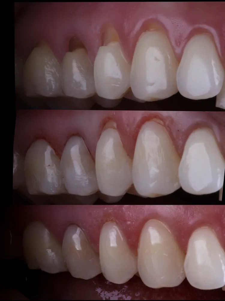 Três etapas de tratamento com a técnica BOPT, vista lateral dos dentes superiores e da gengiva, do estado inicial ao resultado final