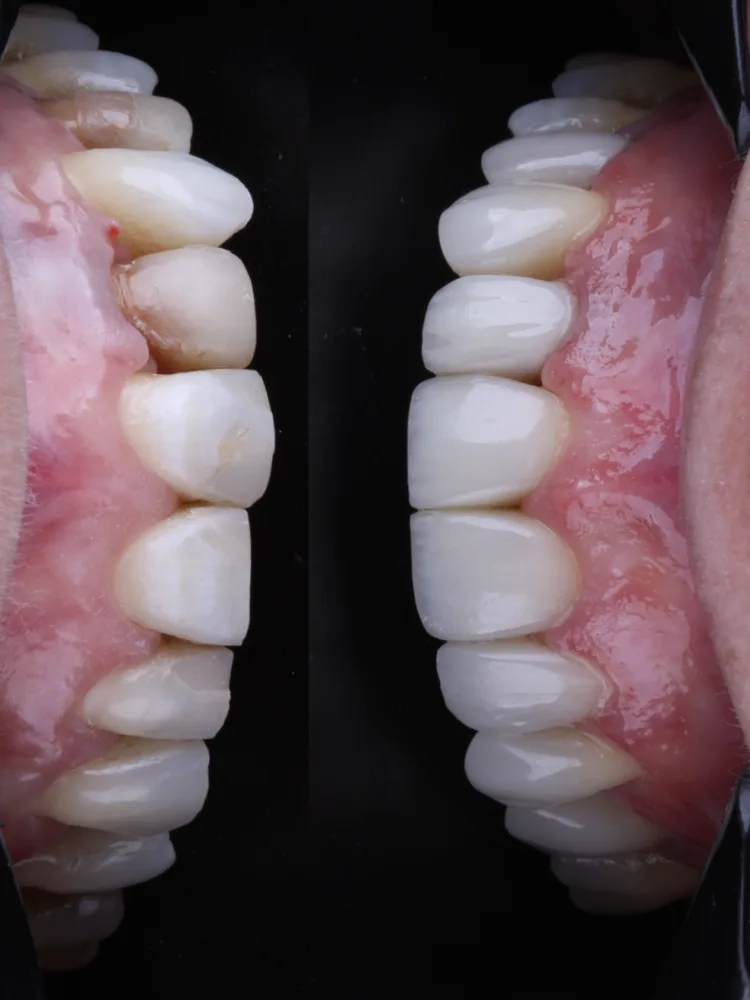 Facetas em resina composta vistas dos dois lados da arcada superior, com dentes de formato e cor naturais
