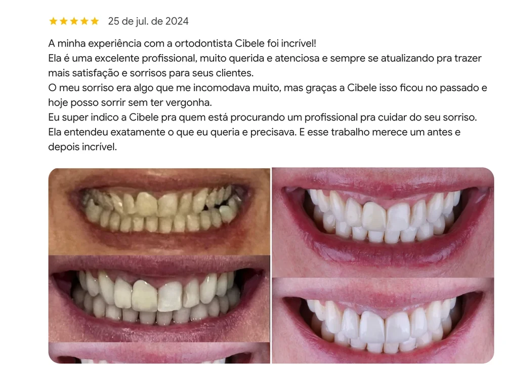Avaliação de 5 estrelas no Google: “O meu sorriso era algo que me incomodava muito, mas graças a Cibele isso ficou no passado e hoje posso sorrir sem ter vergonha”, com fotos de antes e depois